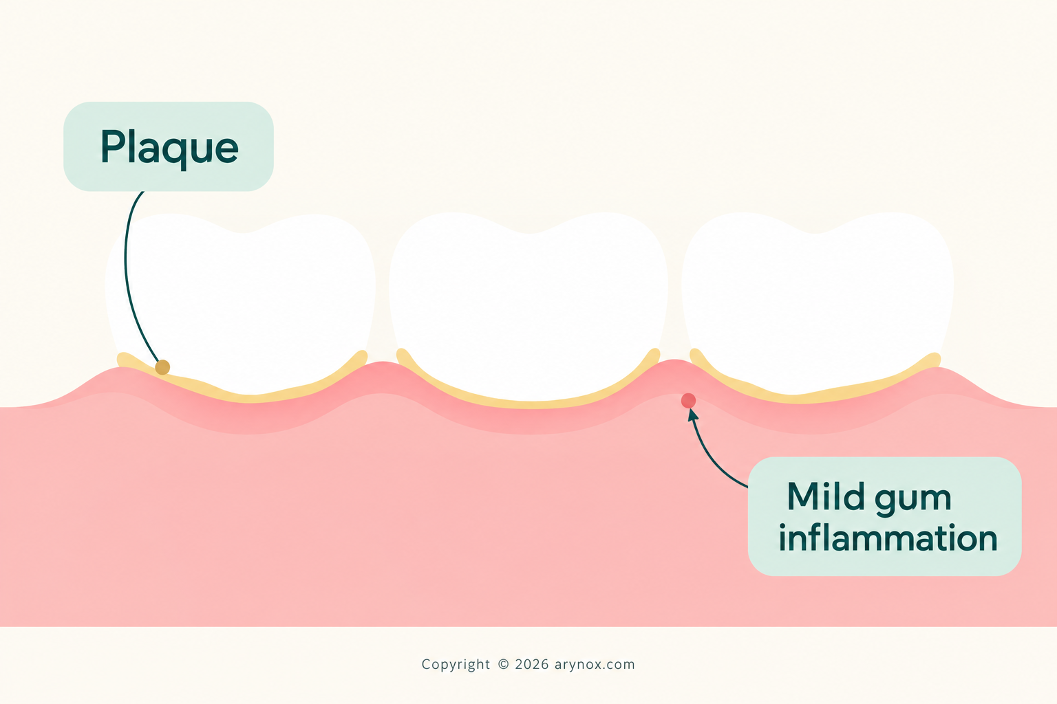 Educational illustration of plaque along the gum line and gum inflammation