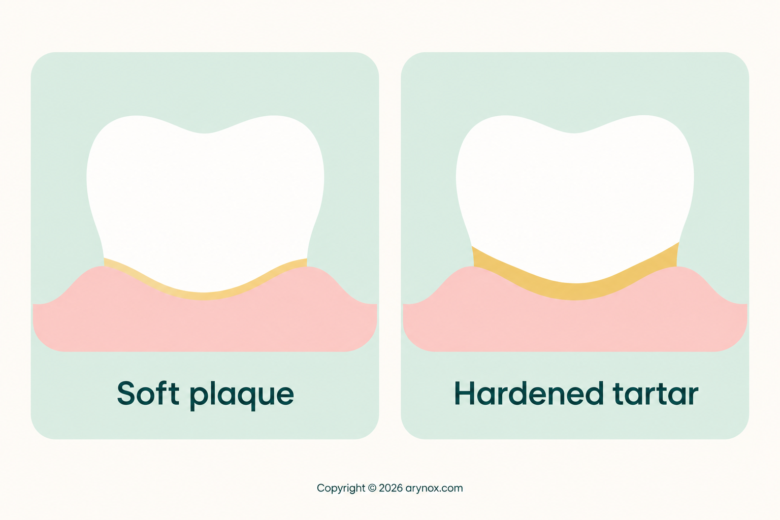 Simple comparison of soft plaque and hardened tartar